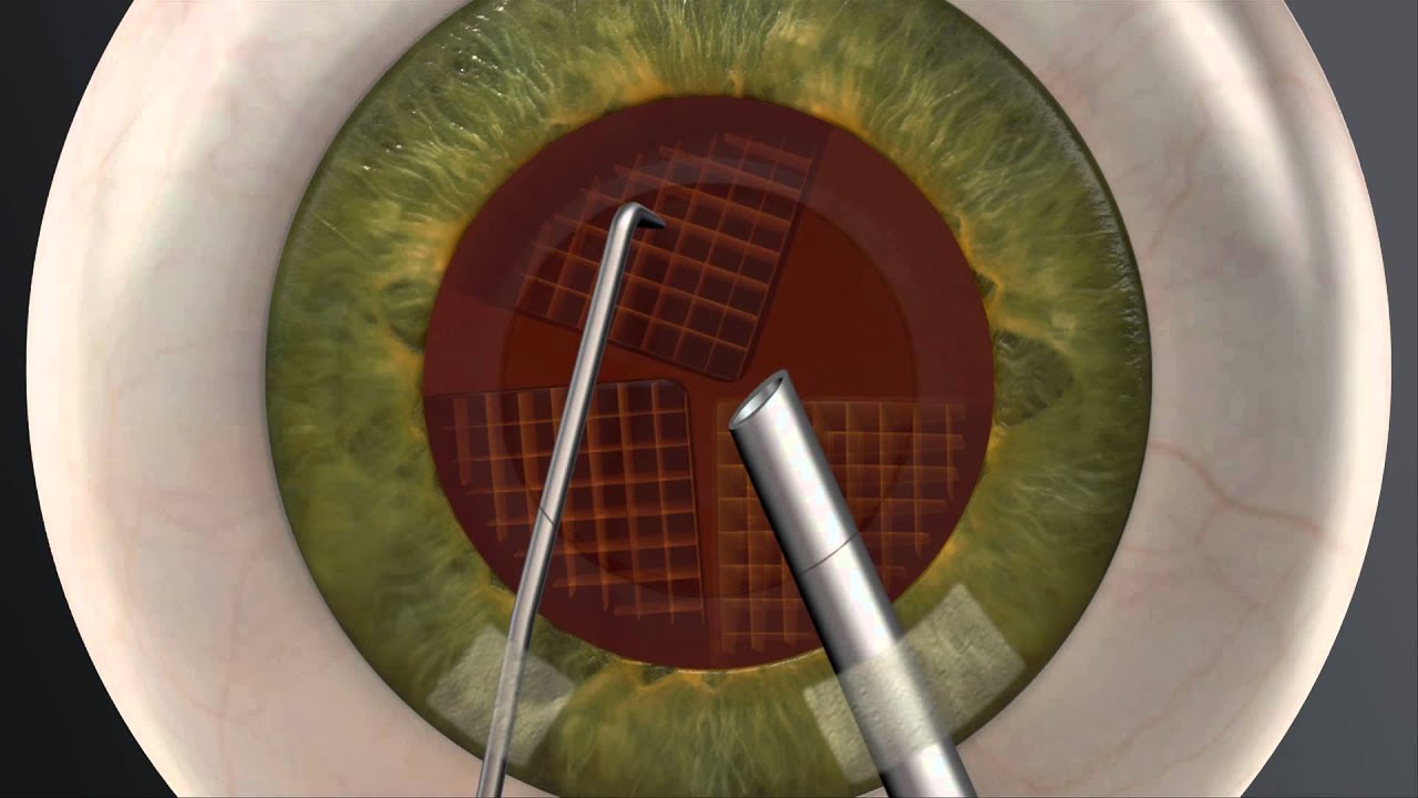 Treatment - Cataract ( Mostibindu ) Surgery in Pune