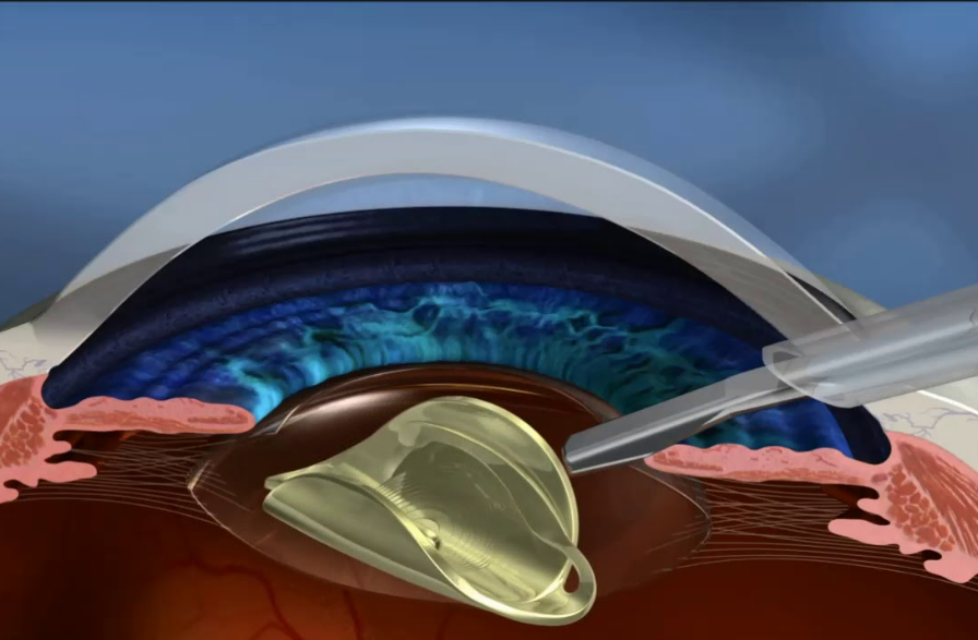 Laser cataract surgery and what is it?