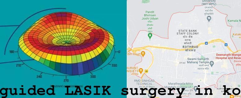 Topo-guided LASIK surgery in Kothrud