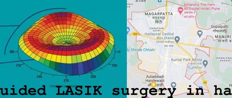 Topo-guided LASIK surgery in Hadapsar