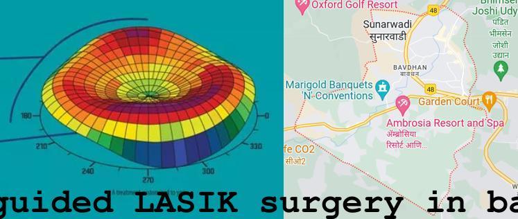 Topo-guided LASIK surgery in Bavdhan