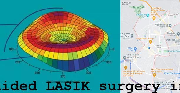 Topo-guided LASIK surgery in Nigdi