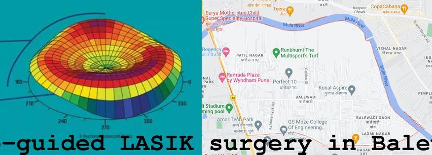 Topo-guided LASIK surgery in Balewadi