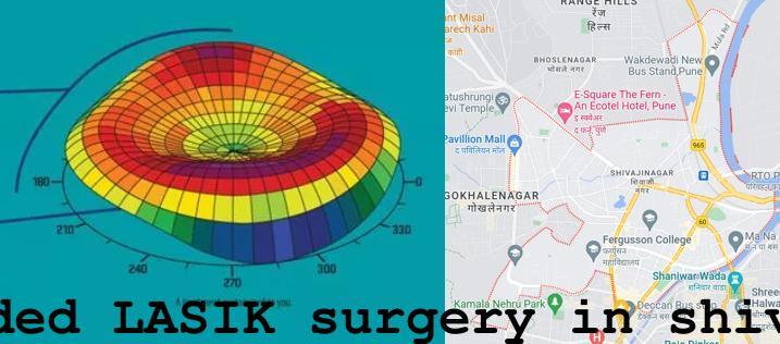 Topo-guided LASIK surgery in Shivajinagar