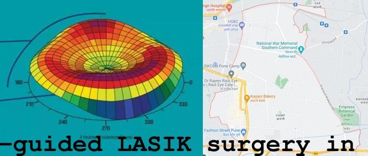 Topo-guided LASIK surgery in Camp